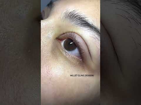 รีวิว หลังทำตาสองชั้น แค่ 4 วัน บวมไม่มีบวม ดูได้เลย หมอกุ๊ก มิลเลท คลินิก