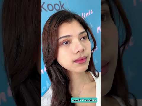 หลังทำตา 7 วัน สวยได้ขนาดนี้ อย่าเพิ่งทำตาที่อื่น ถ้ายังไม่ได้ดูรีวิวที่มิลเลทคลินิก